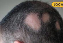 बाल झड़ने लगे हैं तेज़ी से? यह बीमारी हो सकती है जिम्मेदार, जानें बचाव के कुछ जरूरी उपाय – Uttar Pradesh News