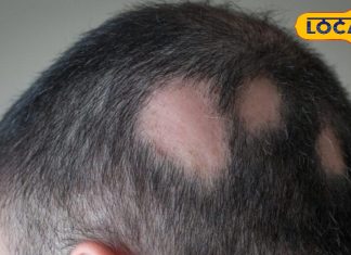 बाल झड़ने लगे हैं तेज़ी से? यह बीमारी हो सकती है जिम्मेदार, जानें बचाव के कुछ जरूरी उपाय – Uttar Pradesh News