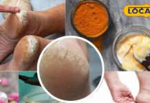 Tips and Tricks: सर्दियों में फटी एड़ियों से परेशान? अपनाएं ये 6 घरेलू नुस्खे, पाएं मुलायम पैर कुछ ही दिनों में