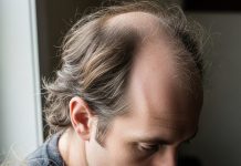 Top 5 Home Remedies for Hair Fall | हेयर फॉल रोकने के लिए 5 घरेलू नुस्खे