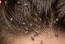 जूं काटने पर सिर में खुजली क्यों होने लगती है? क्या है इसका वैज्ञानिक कारण, जानिए इससे निजात पाने के उपाय