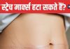 Stretch Marks Causes and Ayurvedic Remedies | स्ट्रेच मार्क्स को पूरी तरह हटाना पॉसिबल है या नहीं