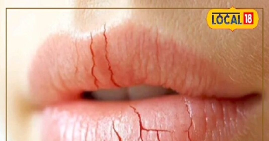सर्दी में होंठ चाटना पड़ेगा भारी, डर्मेटोलॉजिस्ट बोले- लिप डर्मेटाइटिस से होगा दर्द, निकलेगा खून – Madhya Pradesh News