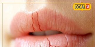 सर्दी में होंठ चाटना पड़ेगा भारी, डर्मेटोलॉजिस्ट बोले- लिप डर्मेटाइटिस से होगा दर्द, निकलेगा खून – Madhya Pradesh News