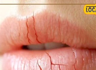 सर्दी में होंठ चाटना पड़ेगा भारी, डर्मेटोलॉजिस्ट बोले- लिप डर्मेटाइटिस से होगा दर्द, निकलेगा खून – Madhya Pradesh News