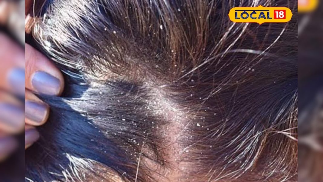 सर्दियों में रूसी से बाल झड़ना हुआ आम, समय रहते अपनाएं ये घरेलू उपचार, वरना गंजेपन के होंगे शिकार