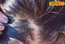 सर्दियों में रूसी से बाल झड़ना हुआ आम, समय रहते अपनाएं ये घरेलू उपचार, वरना गंजेपन के होंगे शिकार