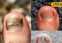 बिना चोट लगे क्यों पक जाता है पैर का अंगूठा, ये वजह पड़ जाती है भारी, छुटकारा आसान, जानें कैसे?