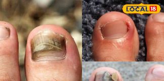 बिना चोट लगे क्यों पक जाता है पैर का अंगूठा, ये वजह पड़ जाती है भारी, छुटकारा आसान, जानें कैसे?