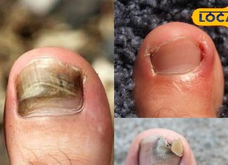 बिना चोट लगे क्यों पक जाता है पैर का अंगूठा, ये वजह पड़ जाती है भारी, छुटकारा आसान, जानें कैसे?