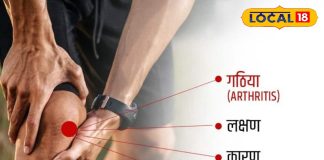 गठिया-जोड़ों के दर्द से हैं परेशान, तो अपनाएं ये उपाय, मिल जाएगी राहत, डाॅक्टर से जानिए इलाज और कारण
