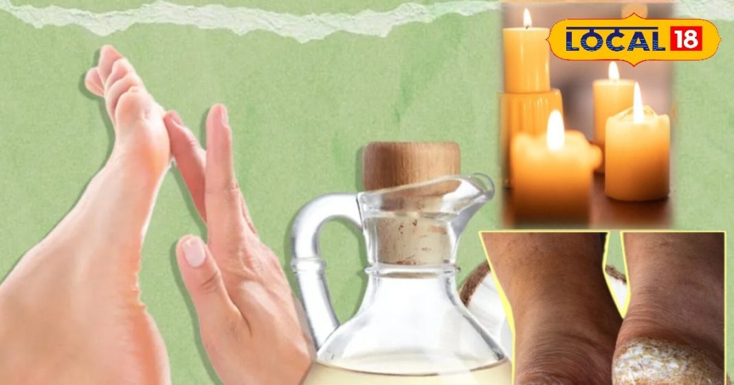 Tips: ठंड में एड़ियां फटने से हैं परेशान? ये घरेलू नुस्खा देगा पक्का राहत, एक्सपर्ट से समझें सब – Madhya Pradesh News