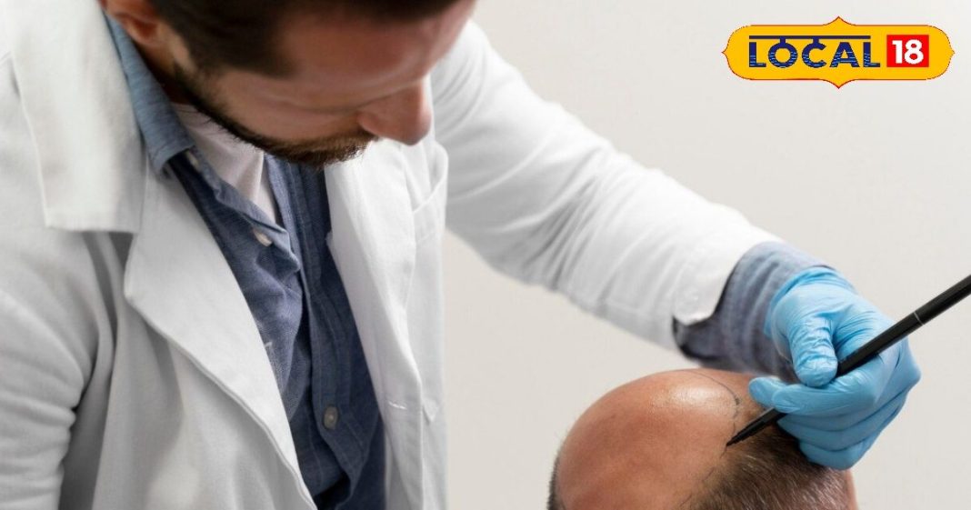 Delhi Top 8 Hair Transplant Doctors: दिल्ली के ये हैं टॉप 8 हेयर ट्रांसप्लांट डाक्टर, सहवाग समेत बदली है हजारों की जिंदगी