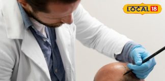 Delhi Top 8 Hair Transplant Doctors: दिल्ली के ये हैं टॉप 8 हेयर ट्रांसप्लांट डाक्टर, सहवाग समेत बदली है हजारों की जिंदगी