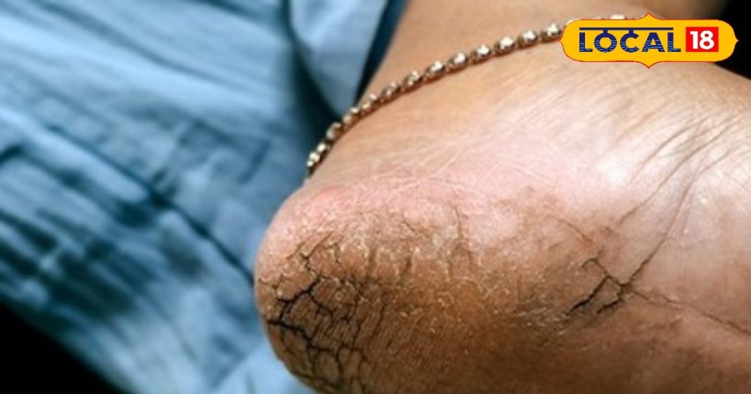 Cracked heels remedy : एड़ी फटने का असली गुनहगार कौन? जानें वो विटामिन जिसकी कमी सर्दियों में ज्यादा खतरनाक – Uttarakhand News