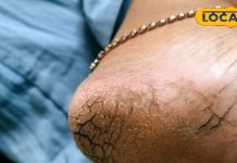 Cracked heels remedy : एड़ी फटने का असली गुनहगार कौन? जानें वो विटामिन जिसकी कमी सर्दियों में ज्यादा खतरनाक – Uttarakhand News