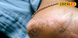 Cracked heels remedy : एड़ी फटने का असली गुनहगार कौन? जानें वो विटामिन जिसकी कमी सर्दियों में ज्यादा खतरनाक – Uttarakhand News