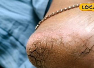 Cracked heels remedy : एड़ी फटने का असली गुनहगार कौन? जानें वो विटामिन जिसकी कमी सर्दियों में ज्यादा खतरनाक – Uttarakhand News