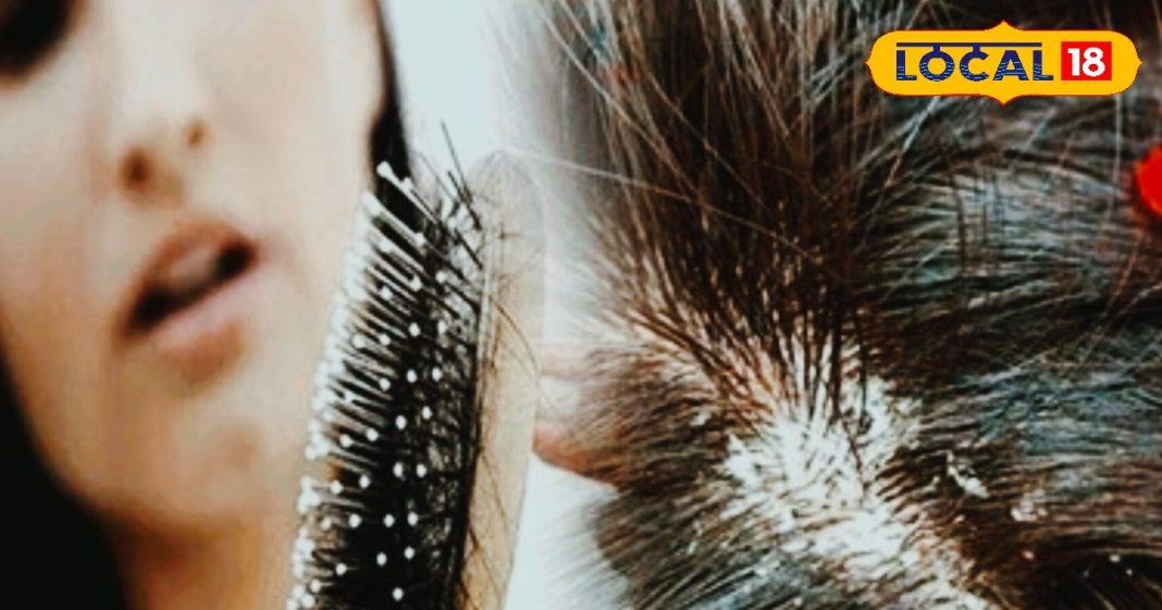सर्दियों में बालों को हेल्दी रखना सबसे बड़ी चुनौती, डैंड्रफ और रूखेपन का करें घर बैठे इलाज – Madhya Pradesh News