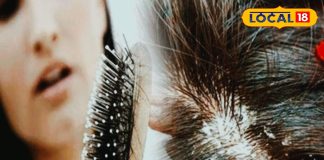 सर्दियों में बालों को हेल्दी रखना सबसे बड़ी चुनौती, डैंड्रफ और रूखेपन का करें घर बैठे इलाज – Madhya Pradesh News