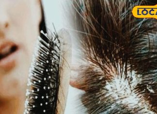 सर्दियों में बालों को हेल्दी रखना सबसे बड़ी चुनौती, डैंड्रफ और रूखेपन का करें घर बैठे इलाज – Madhya Pradesh News