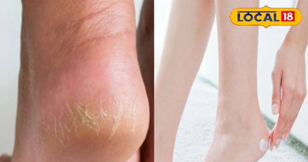 सर्दियों में फटी एड़ियां दे रही हैं तकलीफ? आजमाएं ये 5 खास उपाय, रिजल्ट कर देंगे हैरान – Uttar Pradesh News