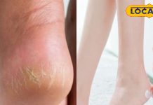 सर्दियों में फटी एड़ियां दे रही हैं तकलीफ? आजमाएं ये 5 खास उपाय, रिजल्ट कर देंगे हैरान – Uttar Pradesh News