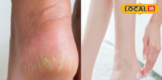 सर्दियों में फटी एड़ियां दे रही हैं तकलीफ? आजमाएं ये 5 खास उपाय, रिजल्ट कर देंगे हैरान – Uttar Pradesh News