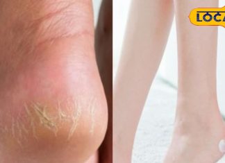 सर्दियों में फटी एड़ियां दे रही हैं तकलीफ? आजमाएं ये 5 खास उपाय, रिजल्ट कर देंगे हैरान – Uttar Pradesh News