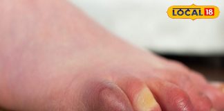 सावधान! सर्दियों में हाथ-पैरों पर अगर दिख रहे यह लक्षण, तो न करें इग्नोर, हो सकती है यह बड़ी बीमारी – Uttarakhand News