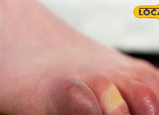 सावधान! सर्दियों में हाथ-पैरों पर अगर दिख रहे यह लक्षण, तो न करें इग्नोर, हो सकती है यह बड़ी बीमारी – Uttarakhand News