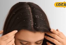 सर्दी में रूसी से बाल हो रहे हैं बेजान? ये घरेलू नुस्खे दिलाएंगे छुटकारा, नोट कर लें हेयरकेयर टिप्स – Uttar Pradesh News