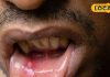 मुंह के छालों ने कर रखा है परेशान? ये तरीका परमानेंट इलाज, डॉक्टर की दवा से भी ज्यादा मारक – Uttarakhand News