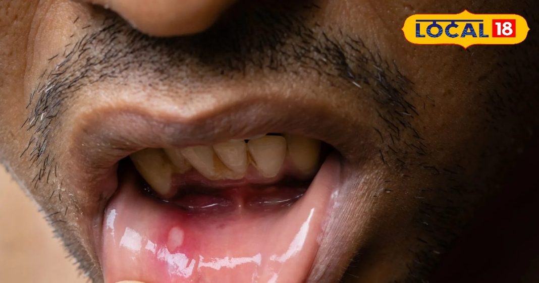 मुंह के छालों ने कर रखा है परेशान? ये तरीका परमानेंट इलाज, डॉक्टर की दवा से भी ज्यादा मारक – Uttarakhand News