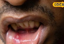 मुंह के छालों ने कर रखा है परेशान? ये तरीका परमानेंट इलाज, डॉक्टर की दवा से भी ज्यादा मारक – Uttarakhand News