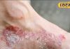 हल्के में ना लें एड़ियों का फटना, हो सकता है सोरायसिस रोग, जमुई के डॉक्टर ने बताया लक्षण और पहचान