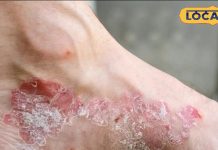 हल्के में ना लें एड़ियों का फटना, हो सकता है सोरायसिस रोग, जमुई के डॉक्टर ने बताया लक्षण और पहचान