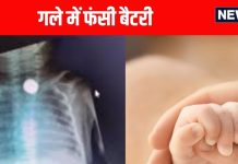 5 महीने के बच्चे की फूड पाइप में फंसी बैटरी, गले में फैला अल्सर, बाल-बाल बची जान