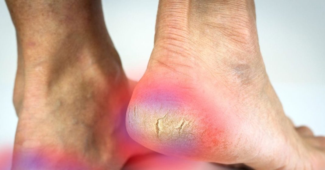 How to fix cracked heels permanently in winter । सर्दियों में 7 कारणों से फटती हैं एड़ियां, ऐसे करें घर पर उपचार