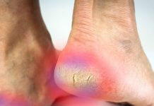 How to fix cracked heels permanently in winter । सर्दियों में 7 कारणों से फटती हैं एड़ियां, ऐसे करें घर पर उपचार