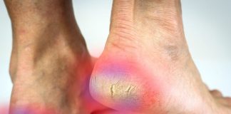 How to fix cracked heels permanently in winter । सर्दियों में 7 कारणों से फटती हैं एड़ियां, ऐसे करें घर पर उपचार