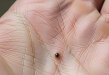 mole or spot on heart line in palmistry | hriday rekha par til hone ka matlab | mole or spot on this part of hand can indicate heart attack risk | हृदय रेखा पर तिल या धब्बे का निशान