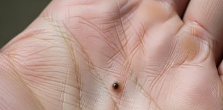 mole or spot on heart line in palmistry | hriday rekha par til hone ka matlab | mole or spot on this part of hand can indicate heart attack risk | हृदय रेखा पर तिल या धब्बे का निशान