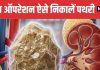 Natural Kidney Stone Treatment Without Surgery | बिना ऑपरेशन किडनी स्टोन निकालने के तरीके