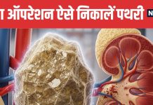Natural Kidney Stone Treatment Without Surgery | बिना ऑपरेशन किडनी स्टोन निकालने के तरीके