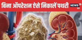 Natural Kidney Stone Treatment Without Surgery | बिना ऑपरेशन किडनी स्टोन निकालने के तरीके