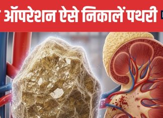 Natural Kidney Stone Treatment Without Surgery | बिना ऑपरेशन किडनी स्टोन निकालने के तरीके