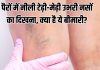 What is varicose veins symptoms and treatment: पैरों की नसें क्यों दिखती हैं टेढ़ी-मेढ़ी, उभरी? क्या है ये बीमारी?