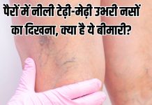 What is varicose veins symptoms and treatment: पैरों की नसें क्यों दिखती हैं टेढ़ी-मेढ़ी, उभरी? क्या है ये बीमारी?