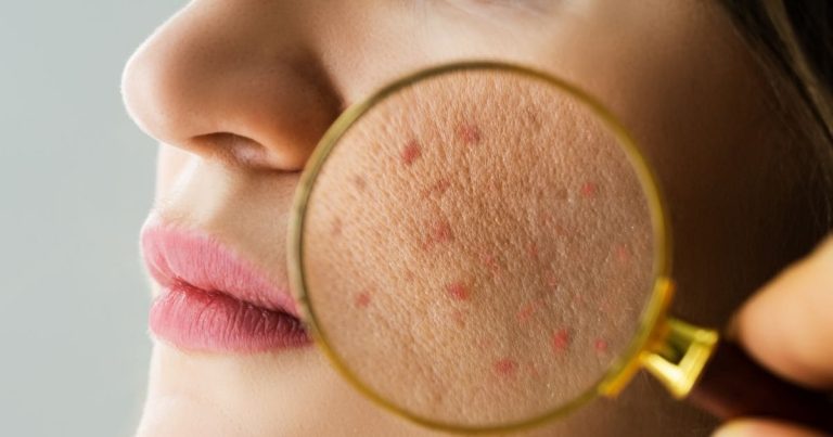 Causes Of Dry Skin| vitamin c deficiency Symptoms| किस विटामिन की कमी से ड्राई होती है स्किन